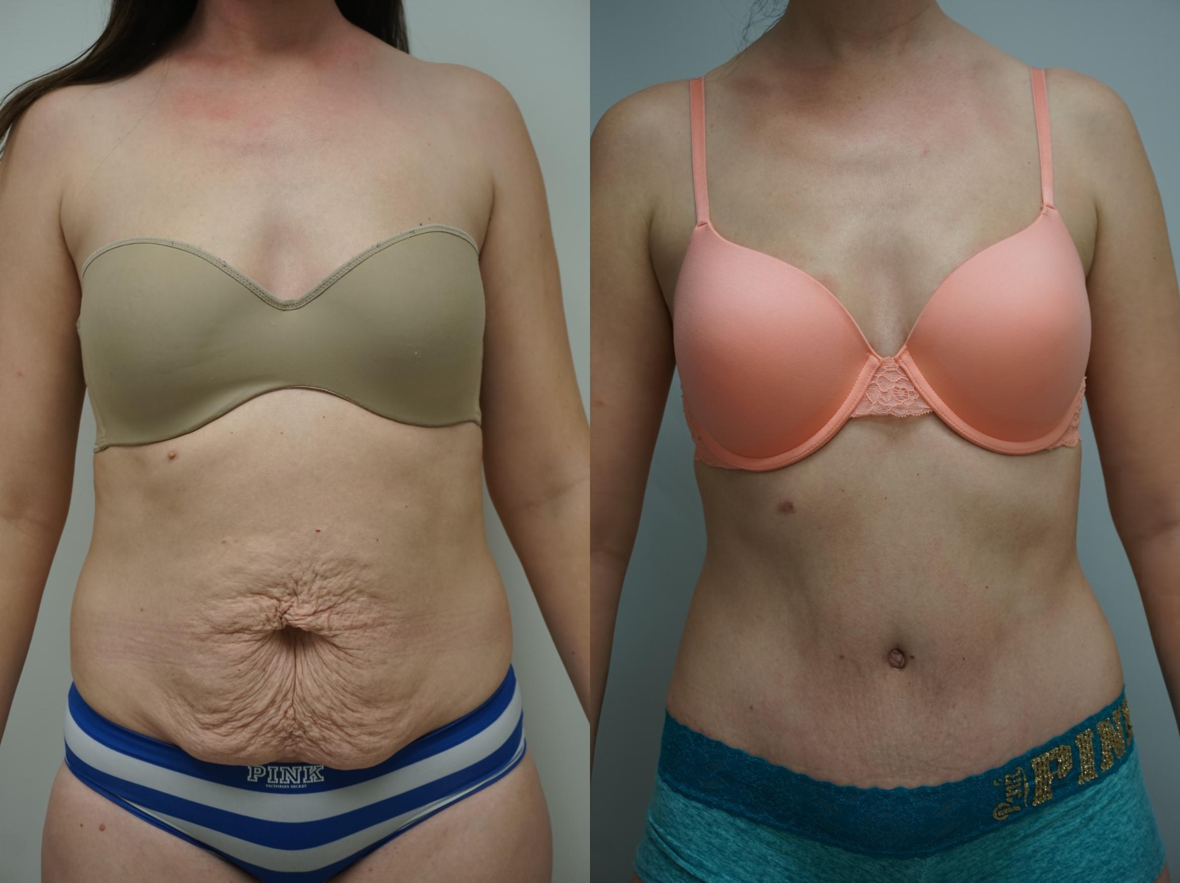 The Search For The Best Tummy Tuck Surgeon In Chicago